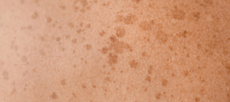 Přiblížená fotografie kůže s více hnědými stařeckými skvrnami.
