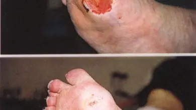 Před a po: hojení těžké vředy na noze diabetika.