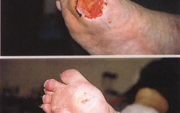 Před a po: hojení těžké vředy na noze diabetika.