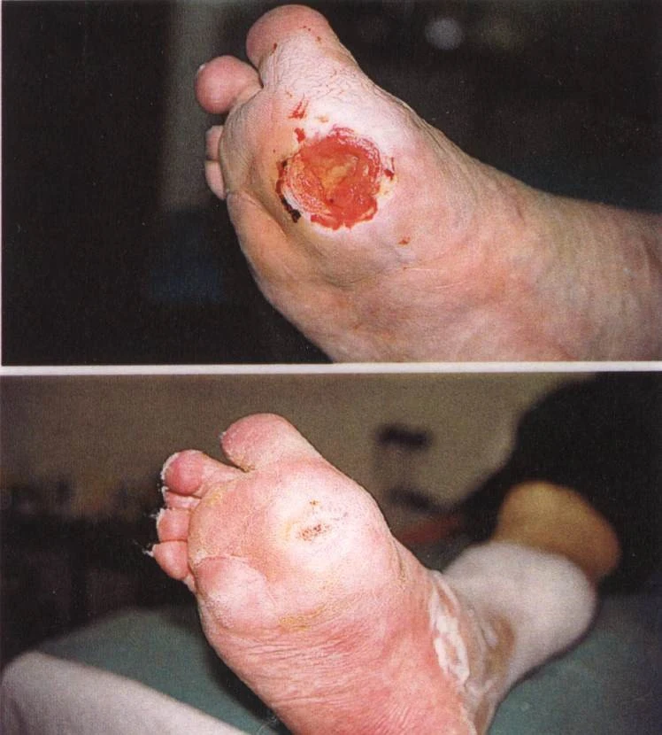 Před a po: hojení těžké vředy na noze diabetika.